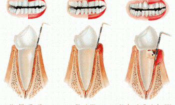 Periodontitas, gingivitas, paradontozė